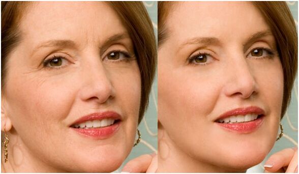 پلازما چہرے کی جلد کو جوان کرنے سے پہلے اور بعد میں۔