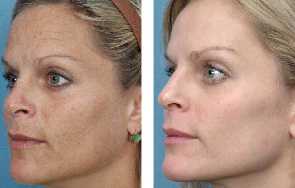 چہرے کی جلد کی تجدید سے پہلے اور بعد میں