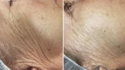 لیزر جلد کی تجدید سے پہلے اور بعد میں