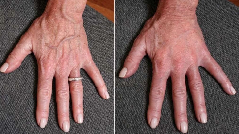 سموچ پلاسٹک ، ہاتھ سے جوان ہونے کی تصویر 1 اس سے پہلے اور بعد میں